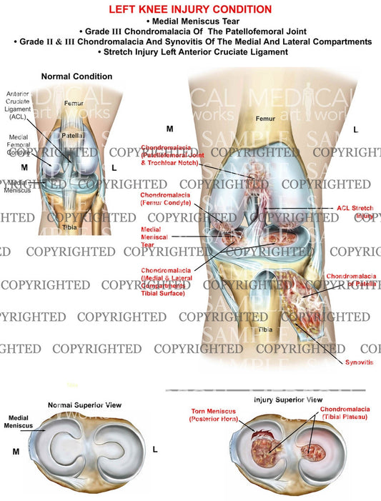 Left Knee Multiple Compartment Injuries