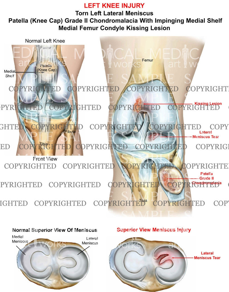 left Knee Injury of the patella and meniscus tear