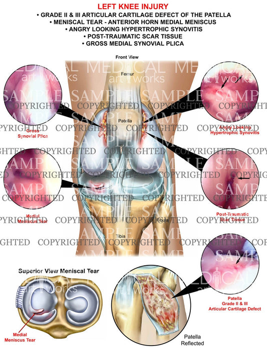 Left knee injury of the patella and meniscus