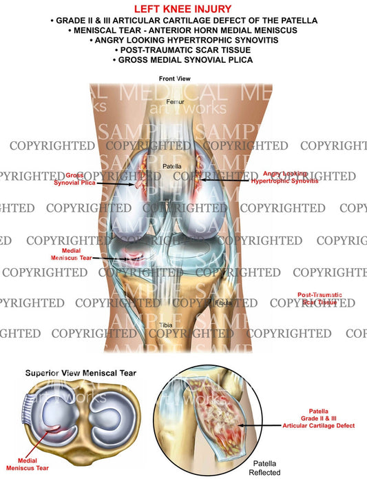 Left knee Injury of the patella and meniscus with synovitis