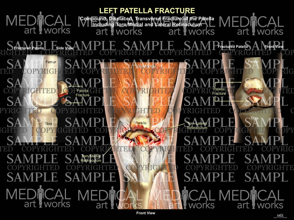 Left Patella Fracture
