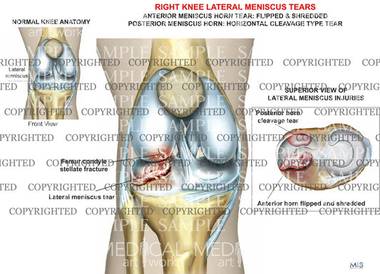 Right Knee Lateral Meniscus Tears