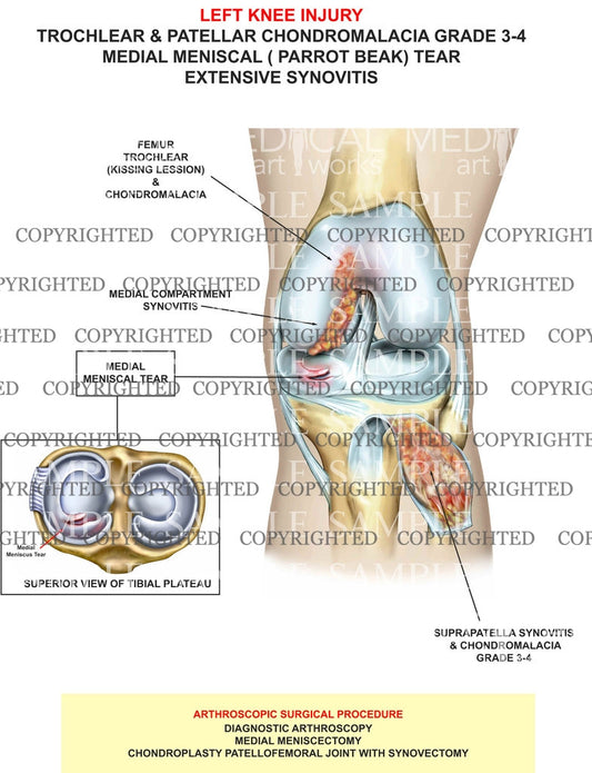 Trochlear & Patellar Chondromalacia