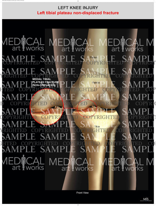 Tibial plateau non-displaced fracture