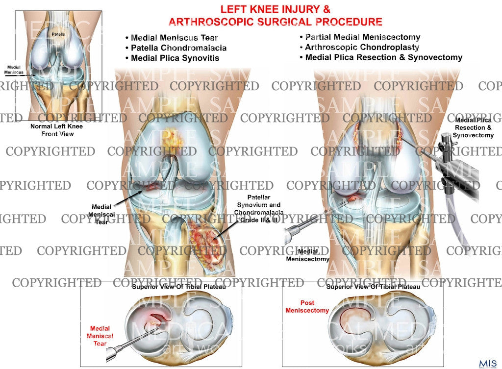 Left knee multiple injuries - meniscus tear - chondromalacia - synovitis and surgical repair