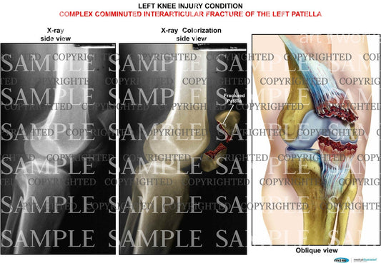 Left knee patella fracture