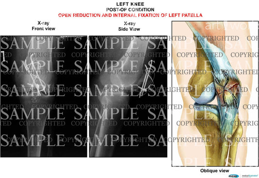 Left Knee patella repair