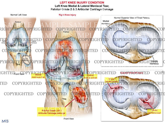 Left Knee Injury Medial & Lateral Meniscal Tear - Patella damage