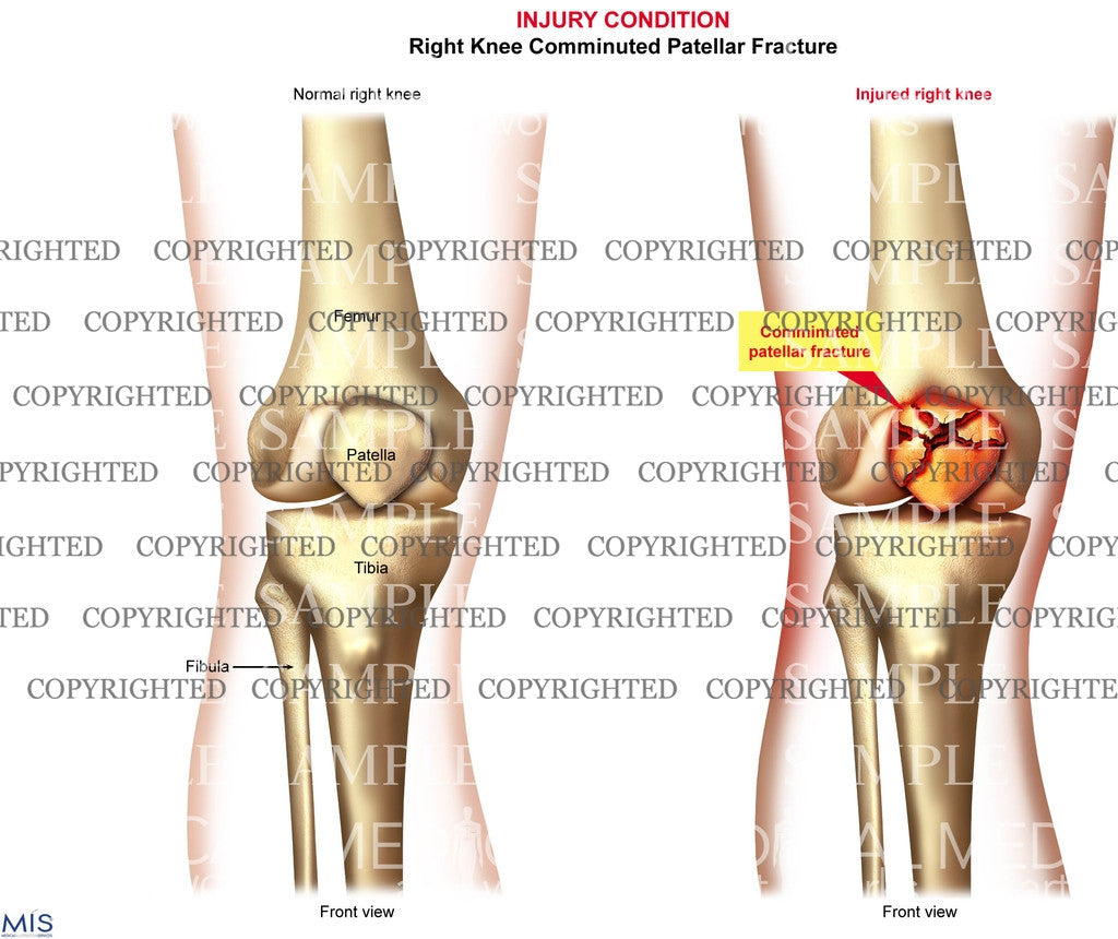 Right Knee Comminuted Patellar Fracture