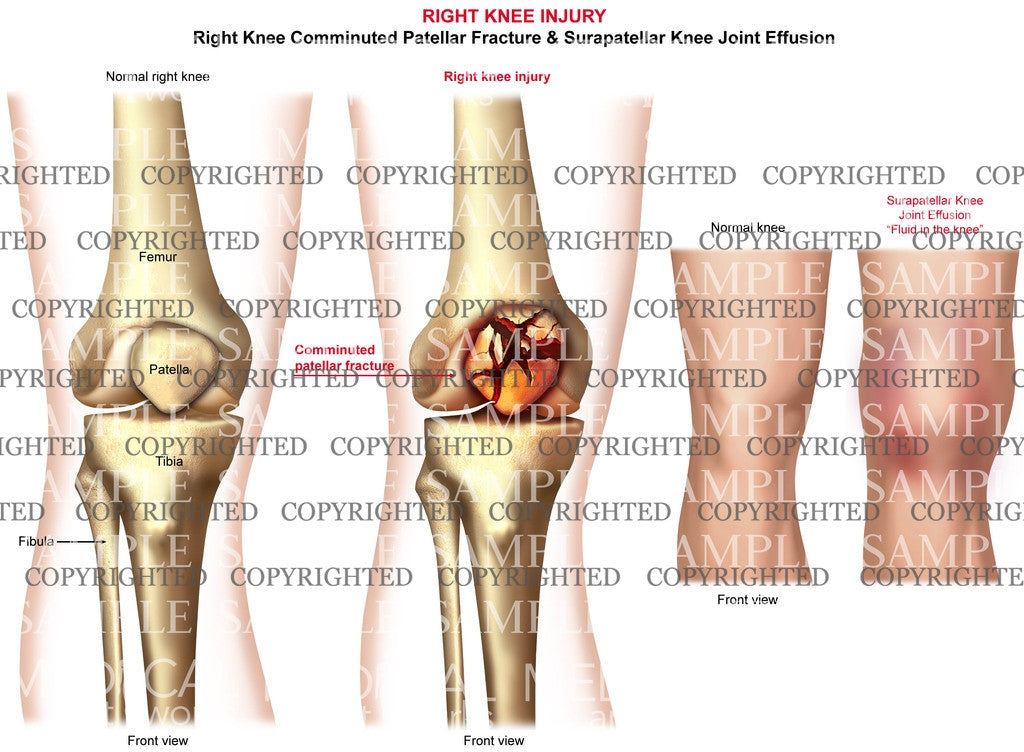 Right knee comminuted patella fracture