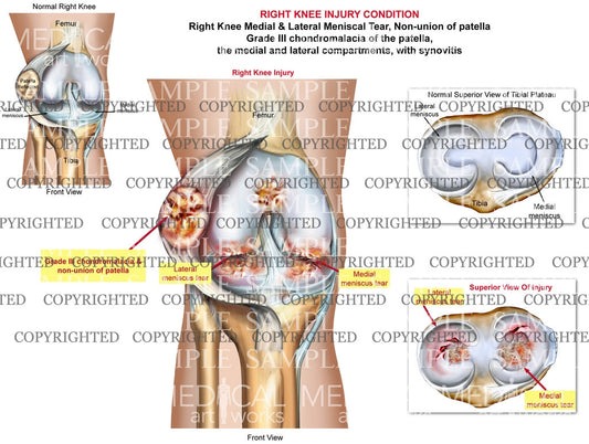 Right knee medial & lateral menisus tear - Chondromalacia - Synovitis