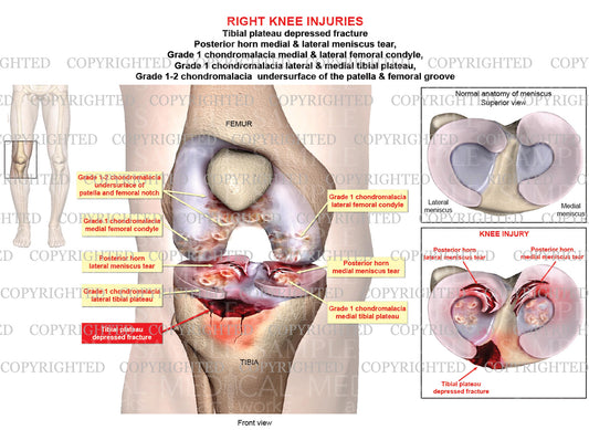 Right knee tibial fracture - Meniscal tears - Chondromalacia