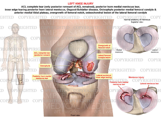 Left knee ACL complete tear - Meniscal tears - Osteophytes - Condyle lesion