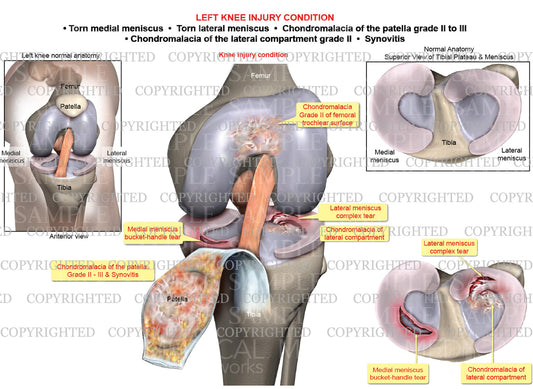 Left knee meniscal tears - Chondromalacia - Synovitis