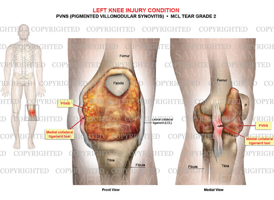 Left knee injury - PVNS ((Pigmented Villonodular Synovitis) - MCL tear grade 2
