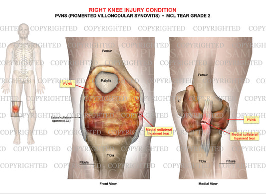 Right knee injury - PVNS ((Pigmented Villonodular Synovitis) - MCL tear grade 2
