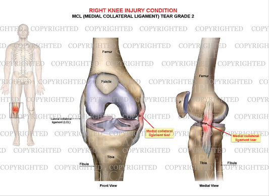 Right knee injury - MCL tear grade 2 - Male