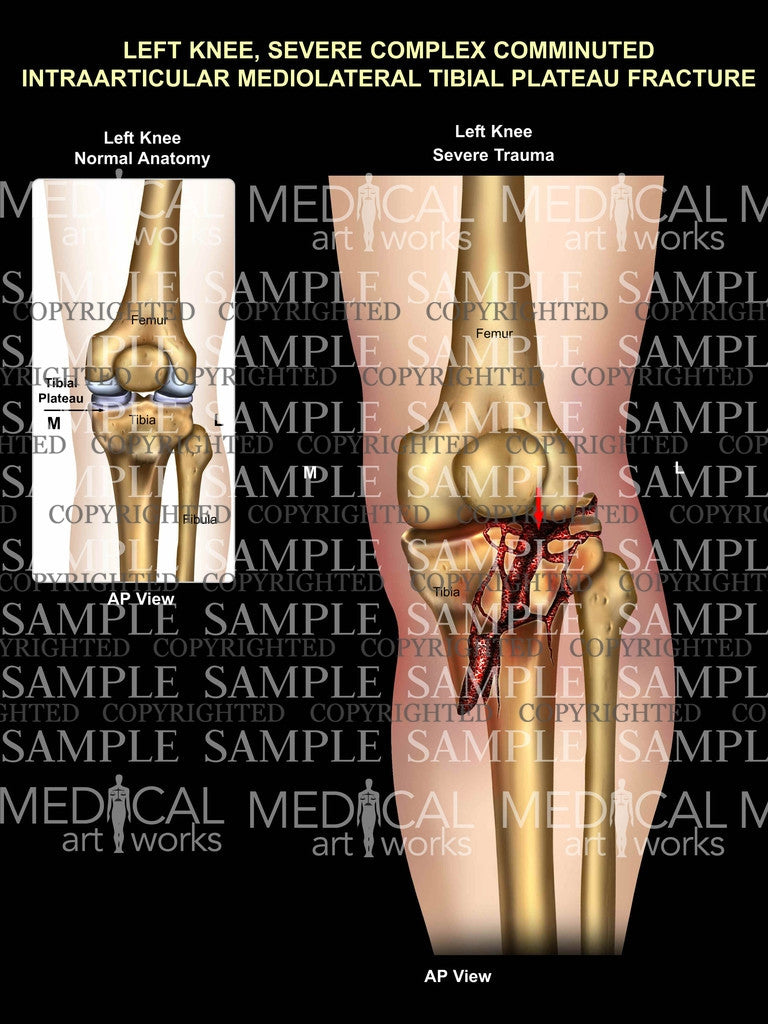 Left Knee tibial plateau fracture