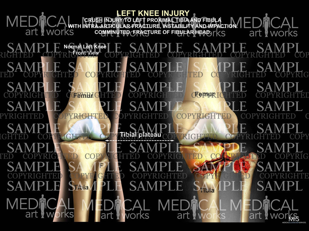 Left Knee Injury of tibia and fibula
