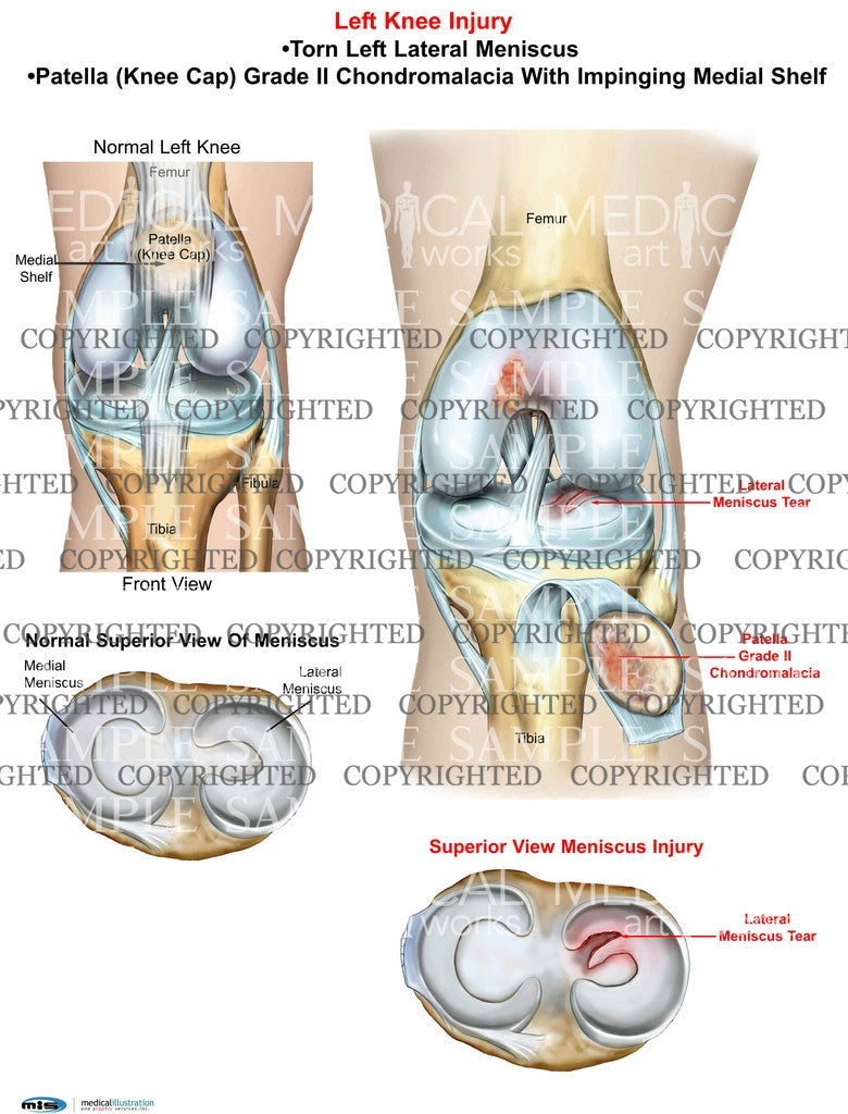 Left Knee lateral meniscus tear and Chondromalacia