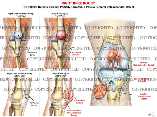 Right Knee Injury Pre-Patellar Bursitis and Patellofemoral Osteochondral Defect