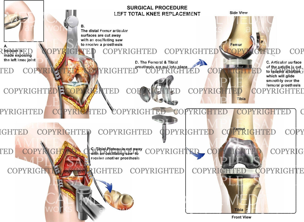 Total Left Knee Replacement
