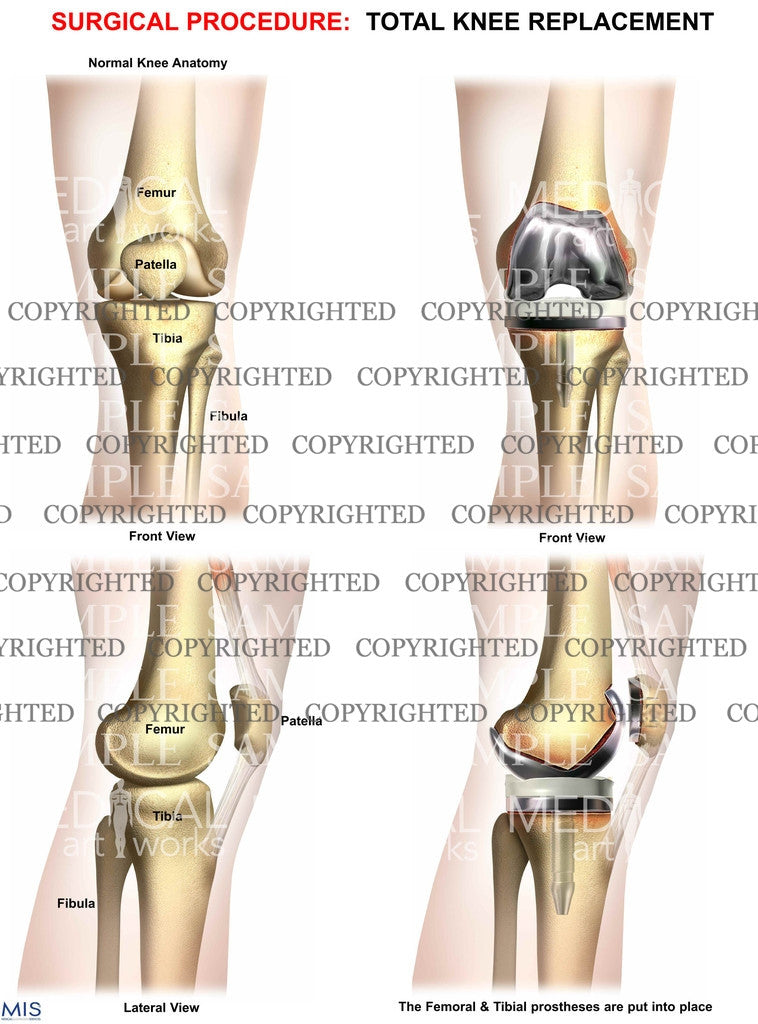 Total Knee Replacement 1