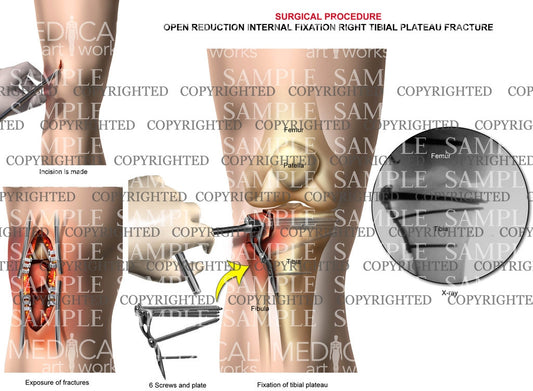Right knee surgical procedure 1