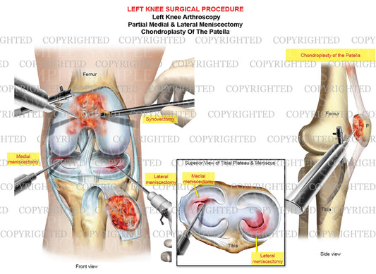 Left knee arthroscopic sugery - medial meniscectomy - chondroplasty