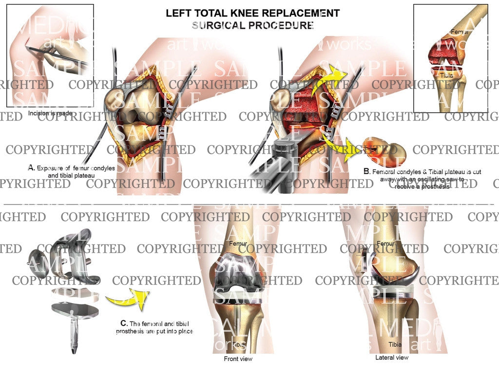 Left Knee Surgical procedure