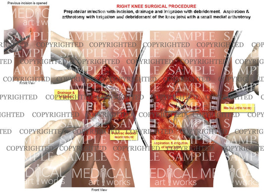 Right Knee irrigation