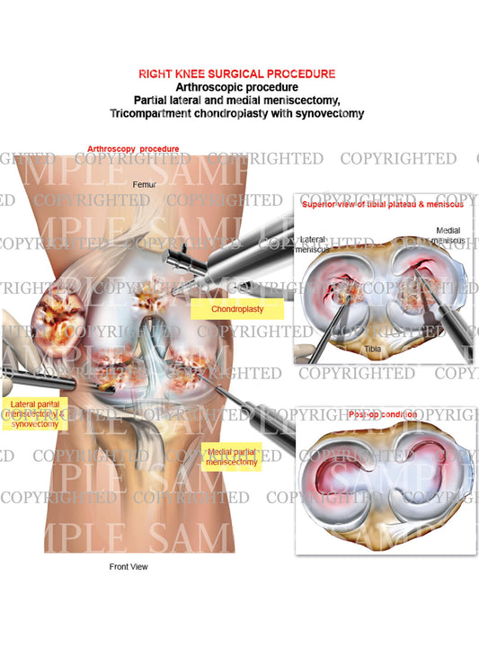 Right knee arthroscopic sugery - medial meniscectomy - chondroplasty - synovectomy