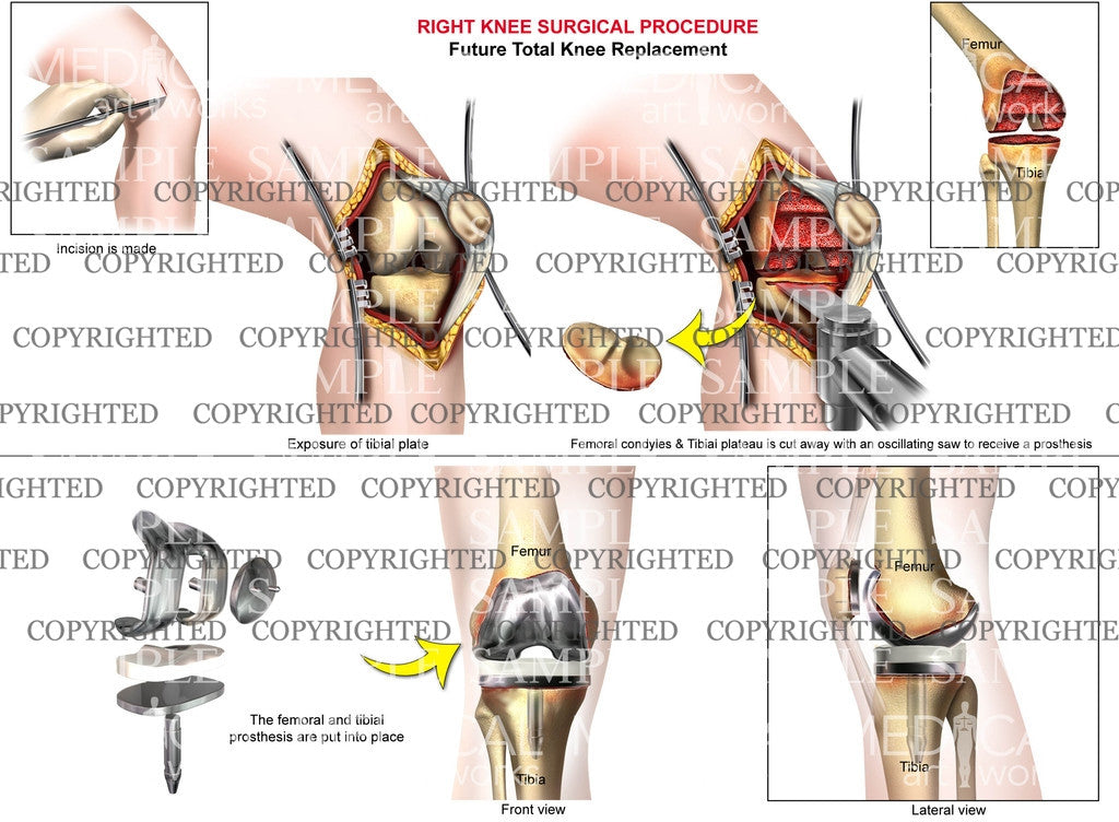 Right Knee Total Knee Replacement
