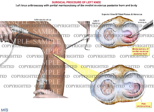 Surgical left knee partial posterior horn meniscectomy procedure