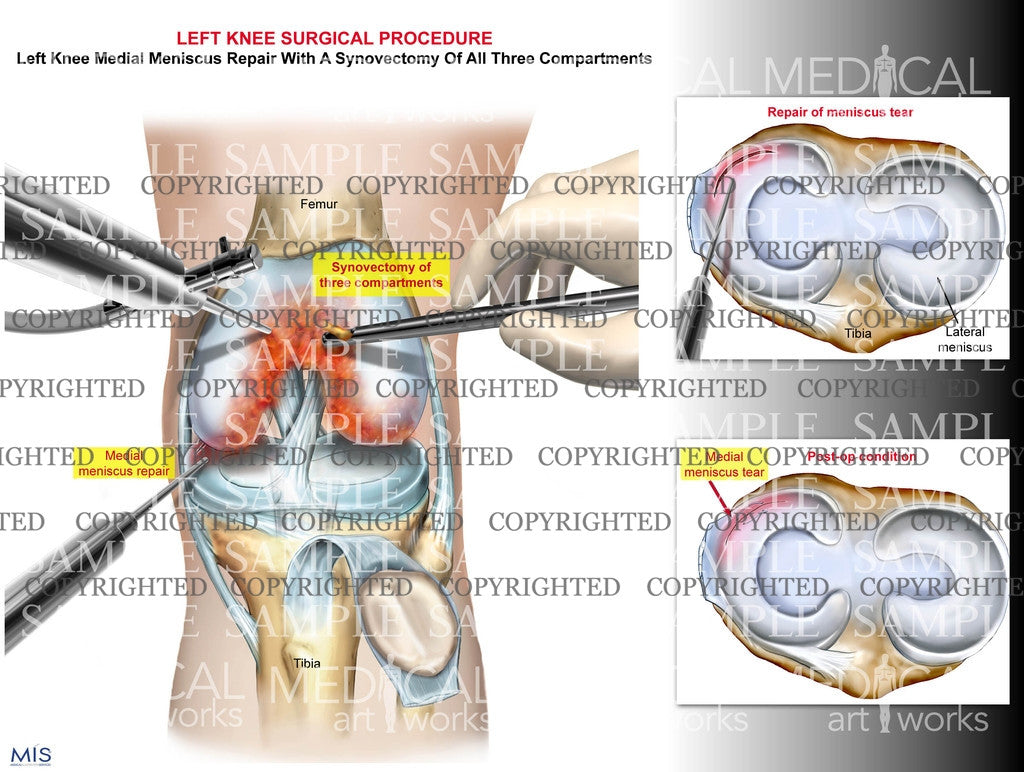 Left knee synovectomy and medial meniscus repair