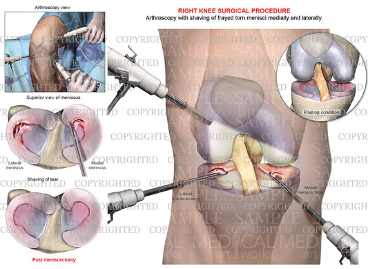 Right Knee Arthroscopy - Medial & Lateral Meniscectomy