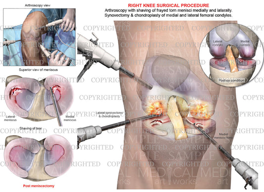Right Knee Arthroscopy - Medial & Lateral Meniscectomy - Chondroplasty - Synovectomy