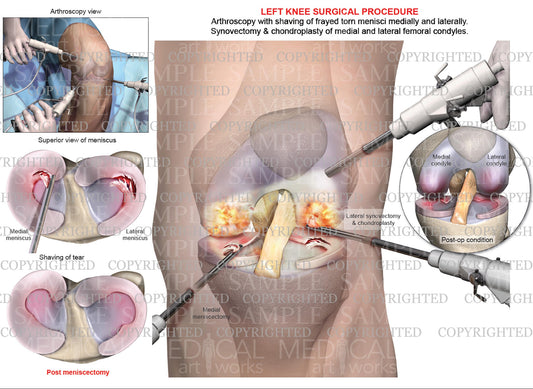 Left Knee Arthroscopy - Medial & Lateral Meniscectomy - Chondroplasty - Synovectomy