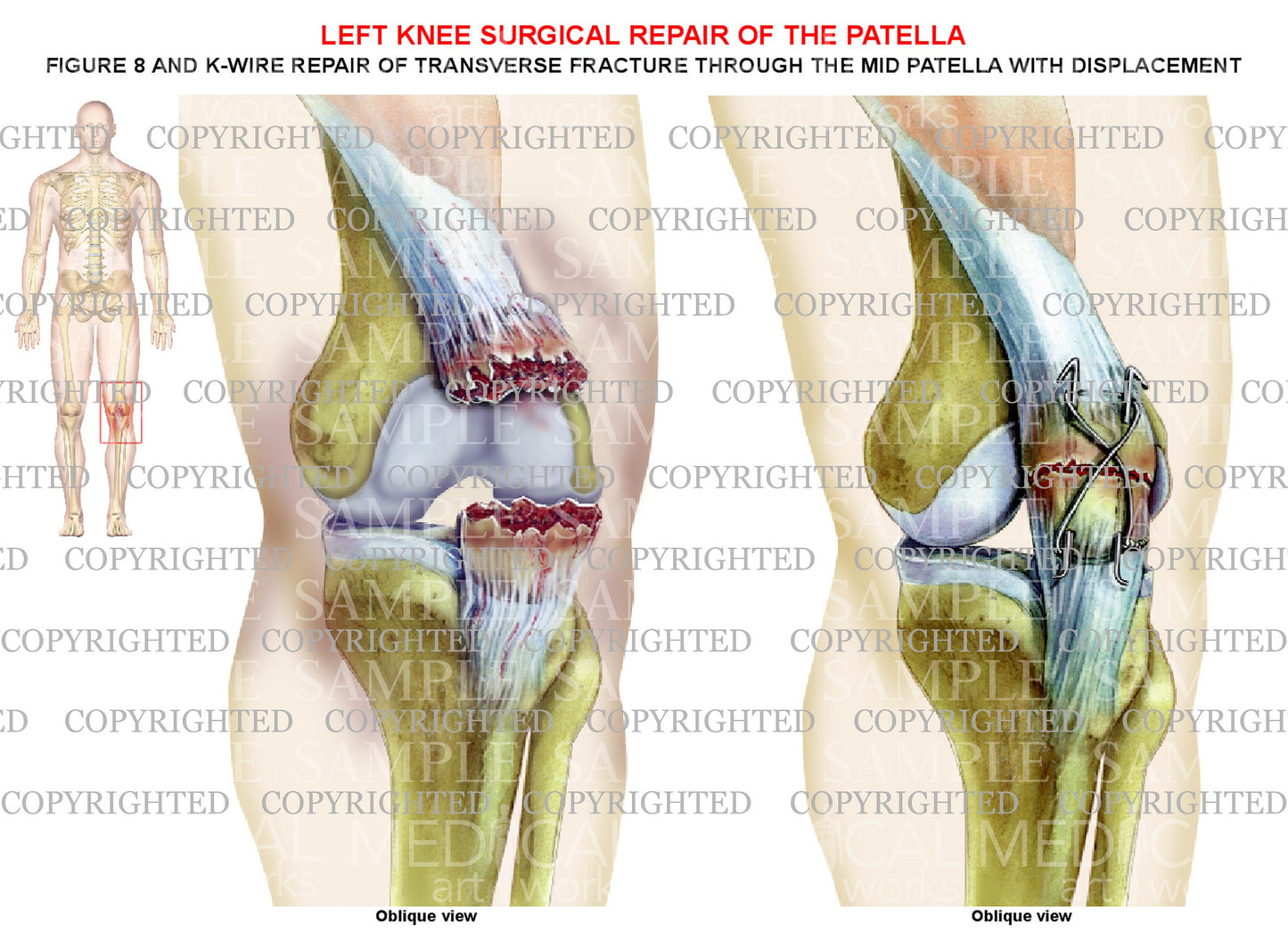 Left patella injury and figure 8 k-wire surgical procedure