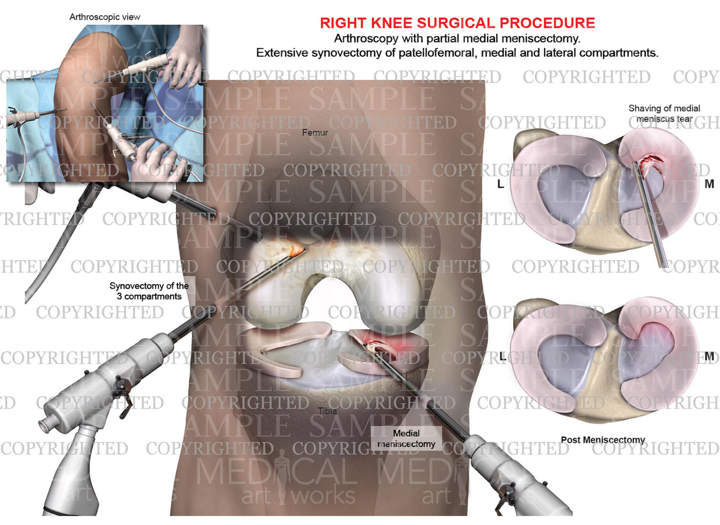Arthroscopy of right knee with partial medial meniscectomy - tricompartmental synovectomy