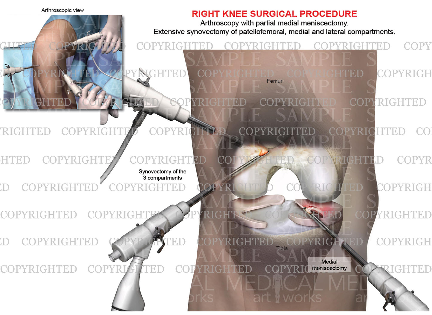 Arthroscopy of right knee with partial medial meniscectomy - synovectomy