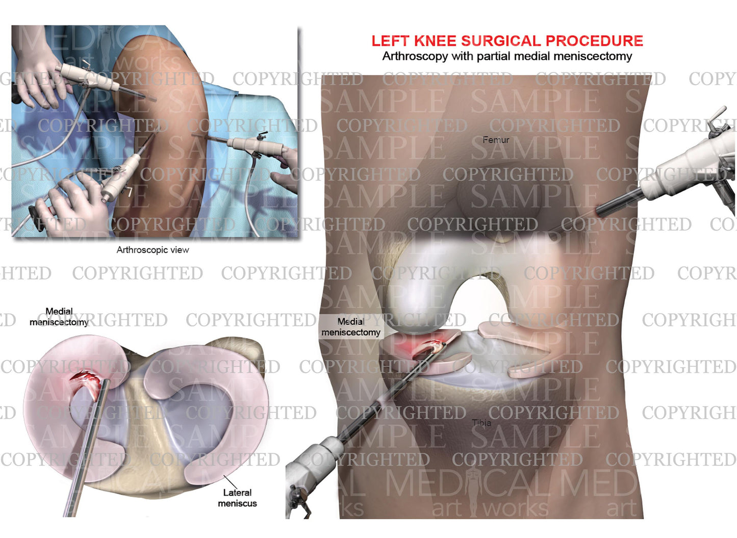 Arthroscopy of left knee with partial medial meniscectomy