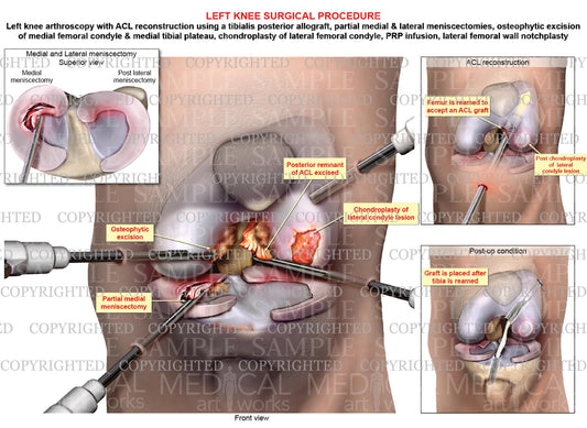 Left Knee Arthroscopy - Meniscectomy - ACL reconstruction - Chondroplasty