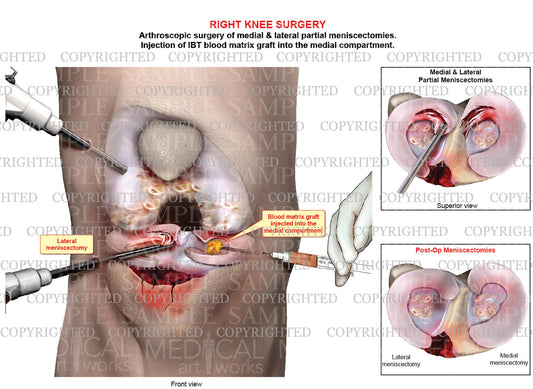 Arthroscopic repair of right knee meniscal tears - IBT blood matrix injection