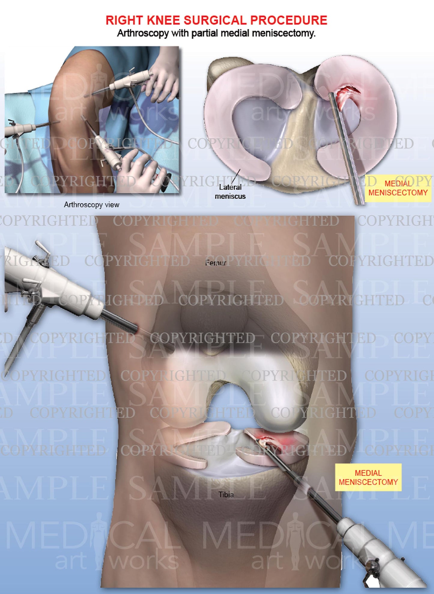 Right Knee Arthroscopy - Medial Meniscectomy