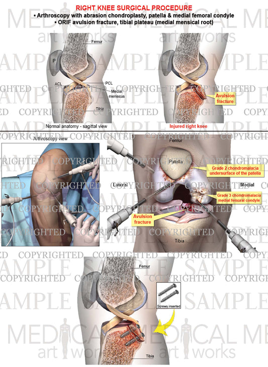 Right Knee Arthroscopy - ORIF avulsion fracture - Chondroplasty