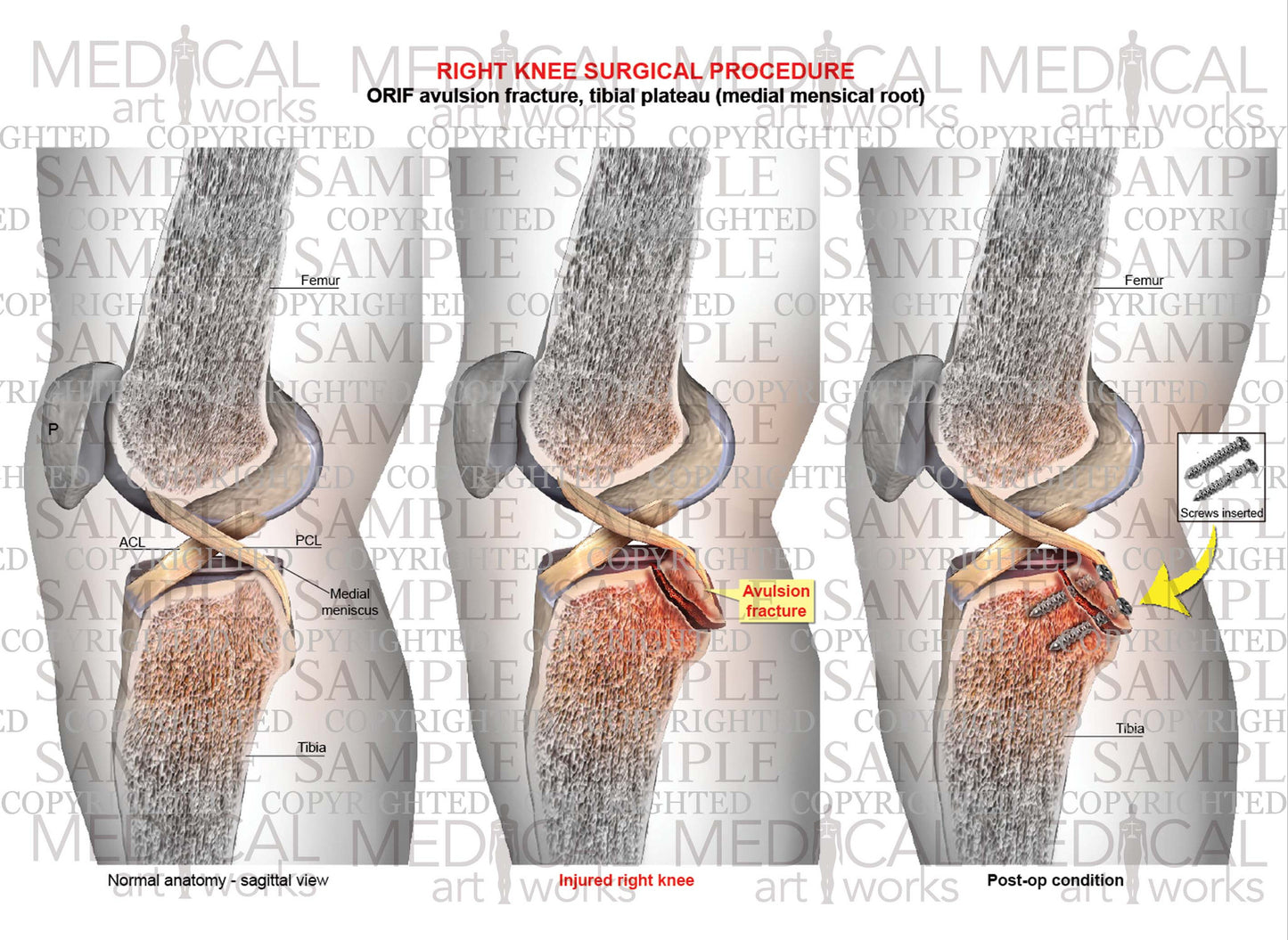 Right Knee Arthroscopy - ORIF avulsion fracture