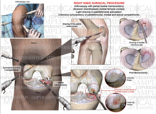 Right knee arthroscopic meniscus and femoral condyle surgery & abrasion chondroplasty