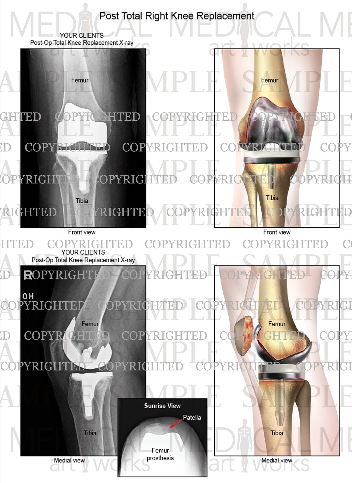 Right Knee Total Knee Replacement - Post-op - x-rays