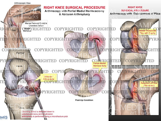 Right knee arthroscopic meniscus and femoral condyle surgery & debridement plica
